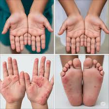 Tay Chân Miệng Mùa Hè Tăng Cao: Cách Bảo Vệ Trẻ Trước Nguy Cơ Lây Nhiễm