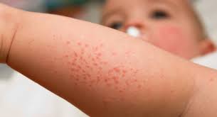 Trẻ Em Dễ Bị Rôm Sảy Trong Ngày Nóng: Cách Nhận Biết Và Xử Trí